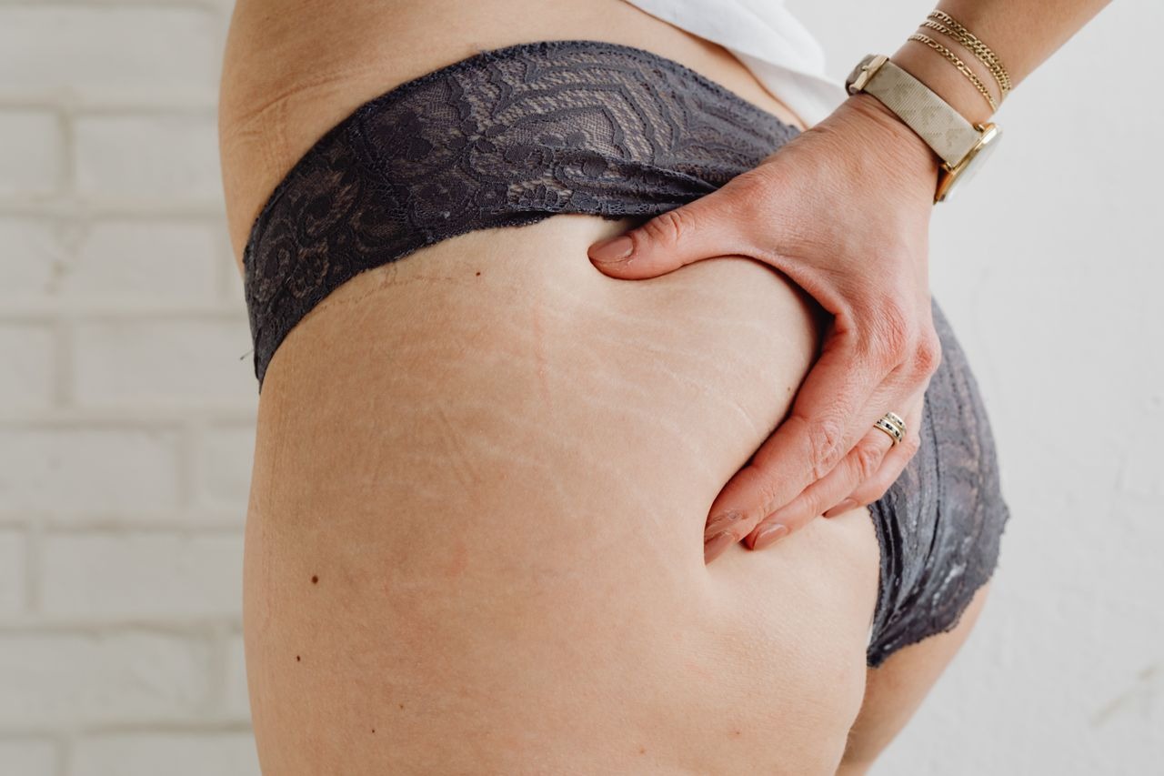 Stretch Mark Akibat Turun Berat Badan? Ini yang Bisa Kamu Lakukan