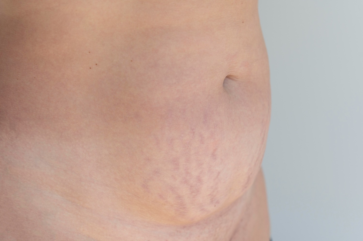 Kenapa Turun Berat Badan Bisa Menyebabkan Stretch Mark?