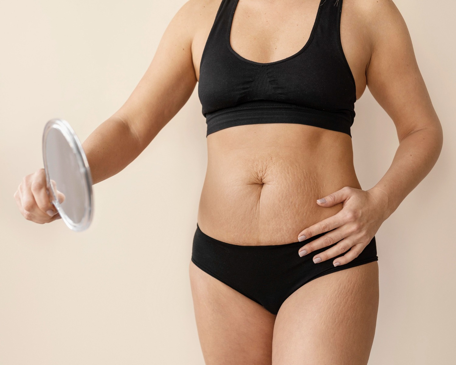 Apa yang Bisa Dilakukan untuk Menyamarkan Stretch Mark?