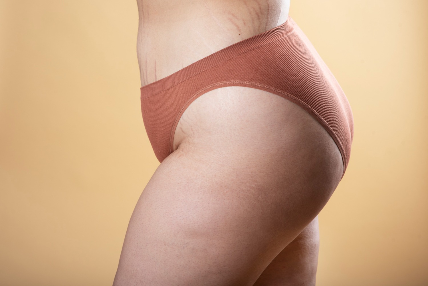 Apakah Stretch Mark Bisa Hilang Sepenuhnya?